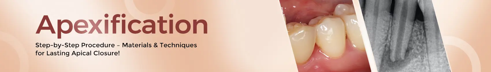 1747833737391-Buying-Guide-Banner---Apexification-DT(1)