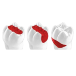 GC EQUIA Forte HT Capsule - Image 3